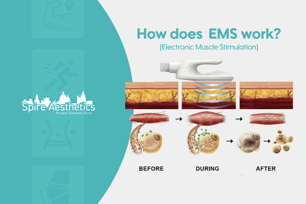 EMS treatment for post pregnancy weight loss treatment Aylesbury