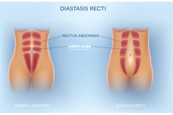 What Non-Surgical Options Are Available for Diastasis Recti Aylesbury?