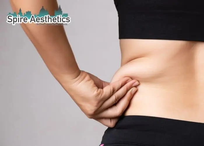 Image of woman pinching fat on their hips Aylesbury. Fat Freezing treatment