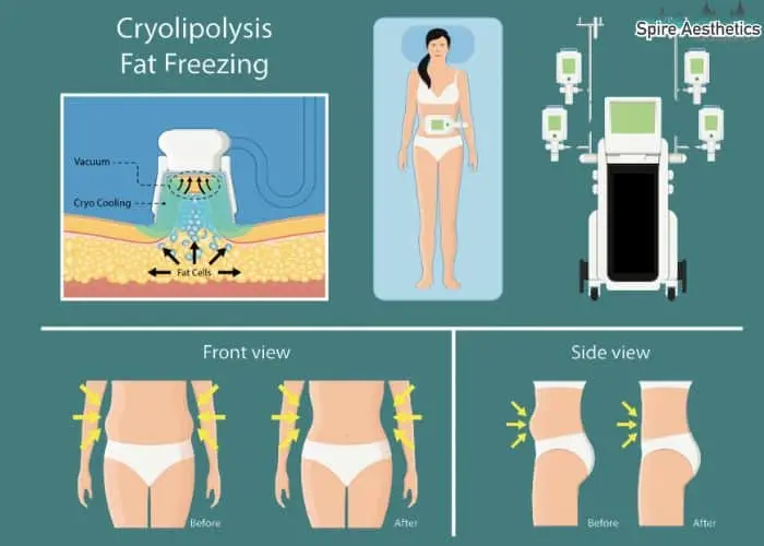 Fat freezing treatment Aylesbury benefits for competitions to remove stubborn fat deposits.