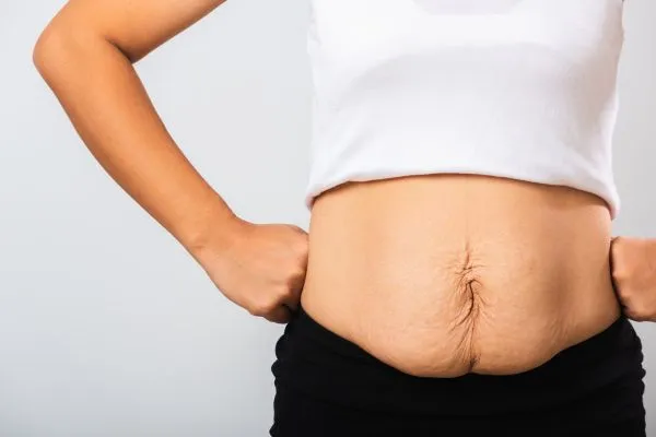 Image of a woman's stomach after weight loss with sagging skin following a gastric band Aylesbury