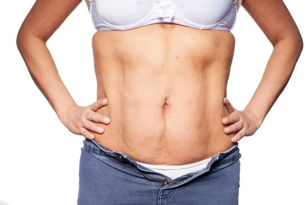 sagging skin on woman's stomach after weight loss injections Aylesbury