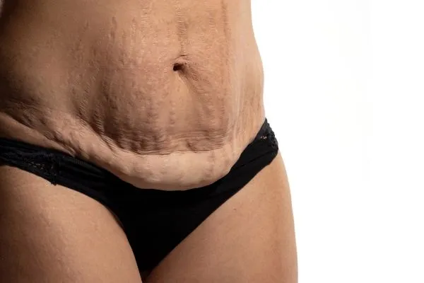 Image of womans stomach after weight loss injections Aylesbury showing saggy skin
