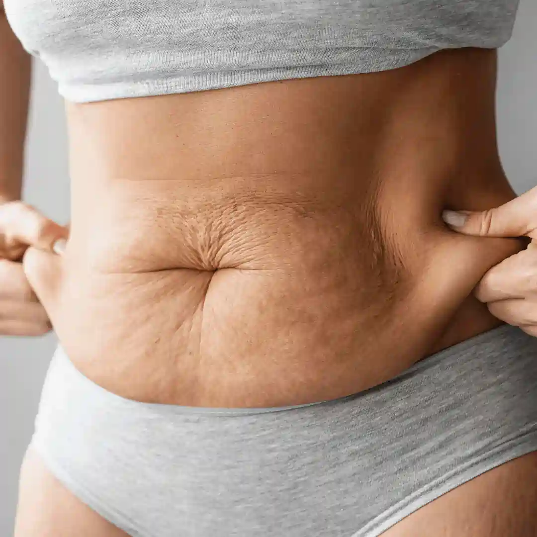 Is It Normal to Have Loose Skin After Pregnancy Aylesbury?