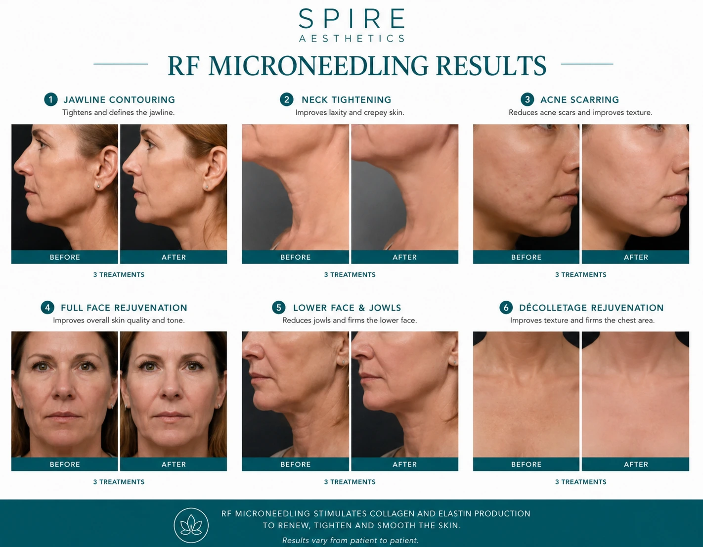 RF Microneedling Skin tightening Aylesbury results