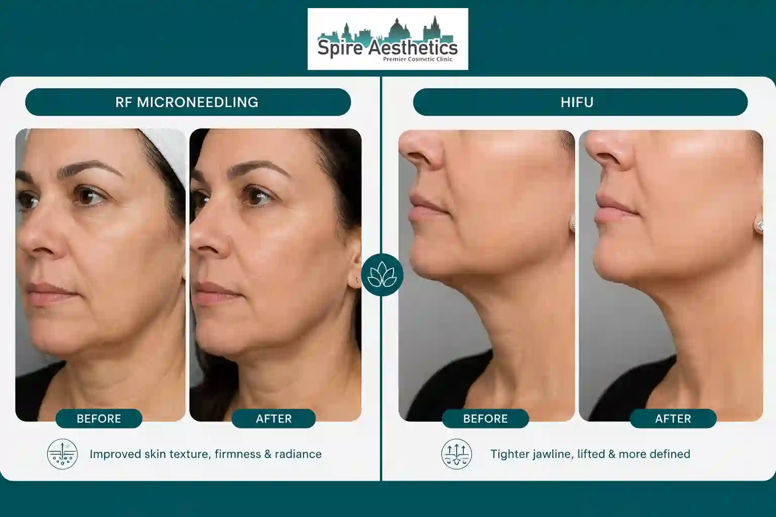 Can RF Microneedling and HIFU Be Combined Aylesbury?