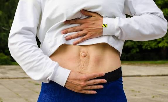 When Could Diastasis Recti Be the Missing Piece of the Puzzle Aylesbury?
