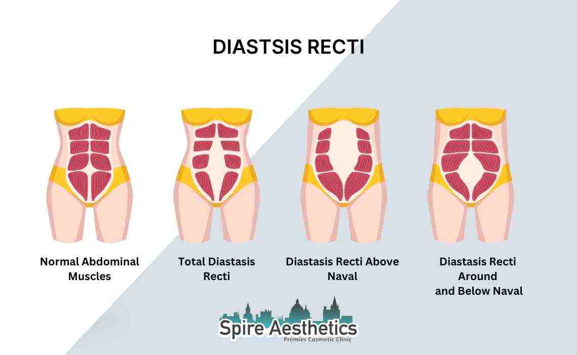 Is Non-Surgical Diastasis Recti Treatment Right for You? Common Concerns Answered Aylesbury